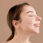 Acne als volwassene: wat je echt kunt doen om puistjes te bestrijden